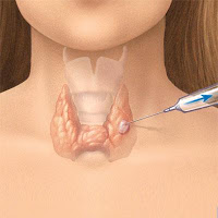 http://2.bp.blogspot.com/-NWCKWRX9NUg/TXvvDNxkwiI/AAAAAAAADmg/EPbFHa16kDA/s400/needle_biopsy_thyroid.jpg